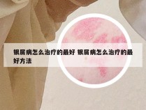 银屑病怎么治疗的最好 银屑病怎么治疗的最好方法