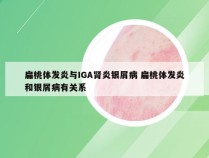 扁桃体发炎与IGA肾炎银屑病 扁桃体发炎和银屑病有关系