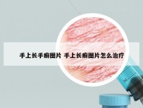 手上长手癣图片 手上长癣图片怎么治疗