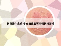 枸骨治牛皮癣 牛皮癣患者可以喝枸杞茶吗