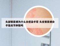 头部银屑病为什么会感染手臂 头皮银屑病会手指关节肿胀吗