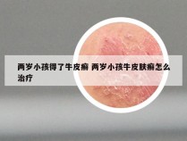 两岁小孩得了牛皮癣 两岁小孩牛皮肤癣怎么治疗