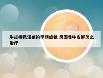 牛皮癣风湿病的早期症状 风湿性牛皮鲜怎么治疗
