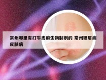 常州哪里有打牛皮癣生物制剂的 常州银屑病皮肤病