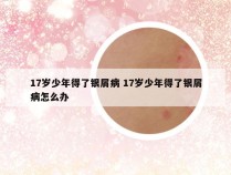 17岁少年得了银屑病 17岁少年得了银屑病怎么办