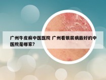 广州牛皮癣中医医院 广州看银屑病最好的中医院是哪家?