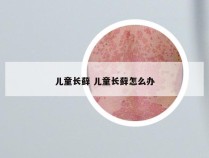 儿童长藓 儿童长藓怎么办