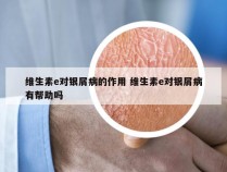 维生素e对银屑病的作用 维生素e对银屑病有帮助吗