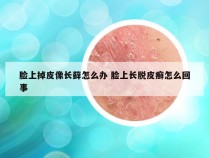 脸上掉皮像长藓怎么办 脸上长脱皮癣怎么回事