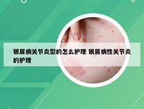 银屑病关节炎型的怎么护理 银屑病性关节炎的护理