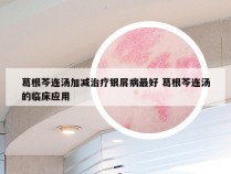 葛根芩连汤加减治疗银屑病最好 葛根芩连汤的临床应用