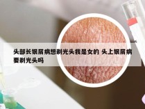 头部长银屑病想剃光头我是女的 头上银屑病要剃光头吗