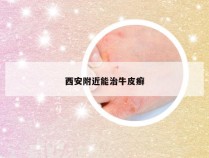 西安附近能治牛皮癣