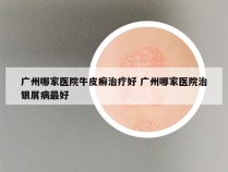 广州哪家医院牛皮癣治疗好 广州哪家医院治银屑病最好