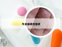 牛皮癣硬疙瘩疼