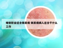 哪些职业适合银屑病 银屑病病人适合干什么工作