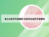 有人针灸只牛皮癣吗 针灸可以治疗牛皮鲜吗