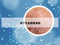 得了牛皮癣爱晕倒