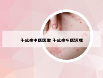 牛皮癣中医医治 牛皮癣中医调理