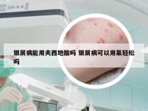 银屑病能用夫西地酸吗 银屑病可以用氟轻松吗
