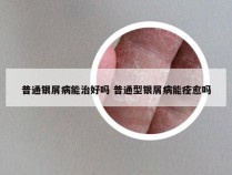 普通银屑病能治好吗 普通型银屑病能痊愈吗
