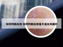 如何判断白斑 如何判断白斑是不是白风图片