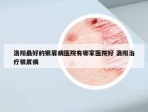 洛阳最好的银屑病医院有哪家医院好 洛阳治疗银屑病