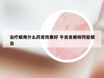 治疗癣用什么药膏效果好 牛皮皮癣如何能根治