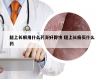 腿上长癣用什么药膏好得快 腿上长癣买什么药