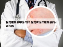 保定银屑病哪治疗好 保定有治疗银屑病的小诊所吗