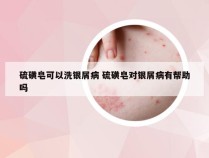 硫磺皂可以洗银屑病 硫磺皂对银屑病有帮助吗