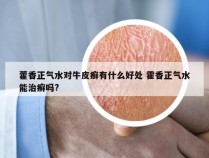 藿香正气水对牛皮癣有什么好处 霍香正气水能治癣吗?