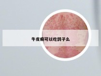 牛皮癣可以吃鸽子么