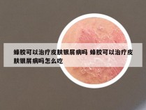 蜂胶可以治疗皮肤银屑病吗 蜂胶可以治疗皮肤银屑病吗怎么吃
