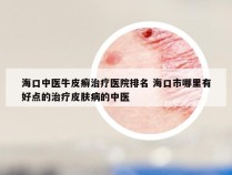 海口中医牛皮癣治疗医院排名 海口市哪里有好点的治疗皮肤病的中医