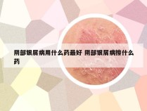 阴部银屑病用什么药最好 阴部银屑病擦什么药