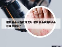 银屑病会大面积爆发吗 银屑病会病变吗?会危及生命吗?