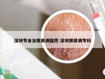 深圳专业治银屑病医院 深圳银屑病专科