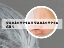 婴儿身上有两个小白点 婴儿身上有两个小白点图片