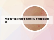 牛皮癣干痛红抹维生素意好吗 牛皮肤癣红霉素