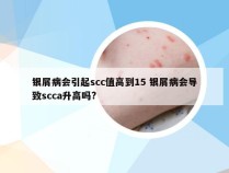 银屑病会引起scc值高到15 银屑病会导致scca升高吗?
