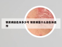银屑病染色体多少号 银屑病是什么染色体遗传