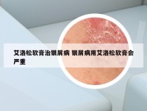 艾洛松软膏治银屑病 银屑病用艾洛松软膏会严重