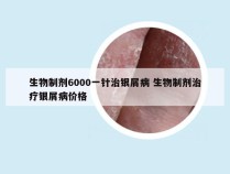 生物制剂6000一针治银屑病 生物制剂治疗银屑病价格
