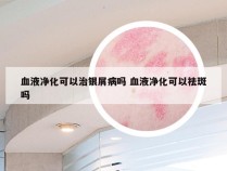 血液净化可以治银屑病吗 血液净化可以祛斑吗