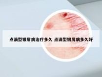 点滴型银屑病治疗多久 点滴型银屑病多久好