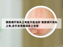 银屑病只有头上有能不能治好 银屑病只有头上有,会不会发展到身上也有