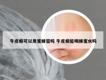 牛皮癣可以用蜜蜂蜇吗 牛皮癣能喝蜂蜜水吗