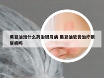 黑豆油泡什么药治银屑病 黑豆油软膏治疗银屑病吗