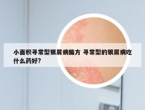 小面积寻常型银屑病偏方 寻常型的银屑病吃什么药好?